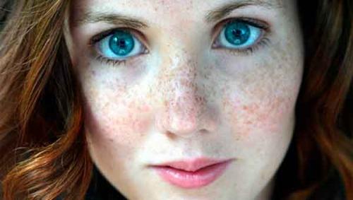 Como alcarar las pecas con algunos de los siguientes remedios naturales